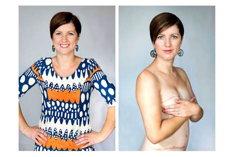 Breast Reconstruction A Cosmetic Procedure Insurers Say NZ Herald