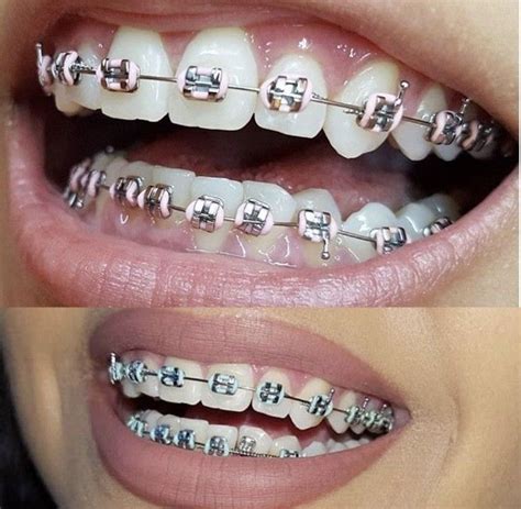 Lista 91 Foto Colores De Brackets Para Mujer Morena Cena Hermosa