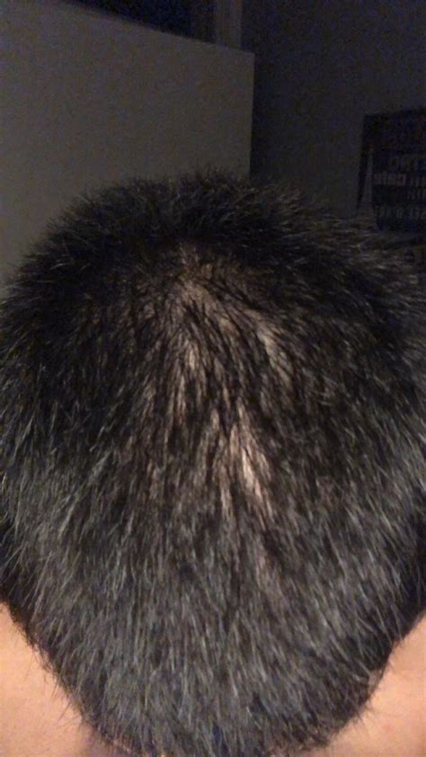 Got A Buzzcut Are These ‘bald Spots Normal Malehairadvice