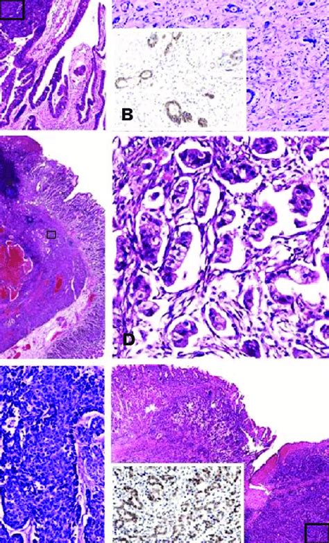 Histological Types Of Proximal Gastric Carcinoma A Adenosquamous