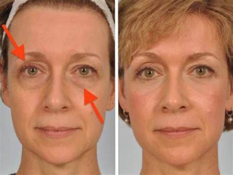 Solve Your Sagging Eyelids Problem Naturally In 2 Minutes