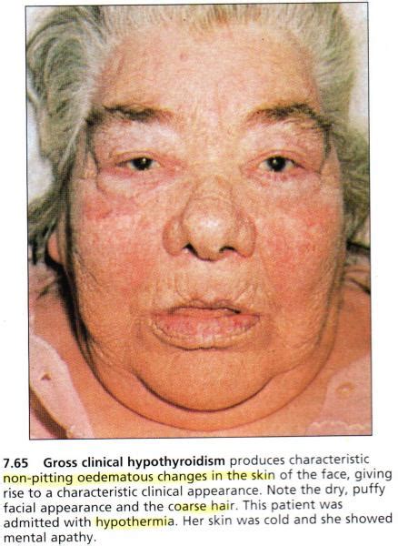 Hypothyroid Hypothyroid Face