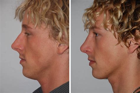 nose job before and after male elhorizonte