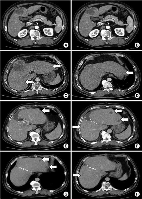 Pre And Postoperative Computed Tomography Ct Scan Findings