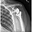 The Why And When Of Shoulder Replacement Surgery  Arthritis Advisor