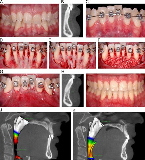 D Guided Comprehensive Approach To Mucogingival Problems In