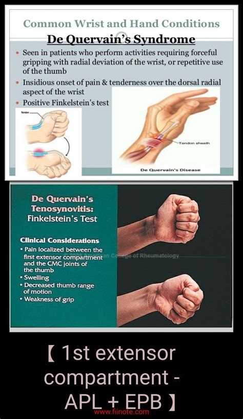De Quervain Syndrome Finkelstein Test Hand Health Hand Therapy