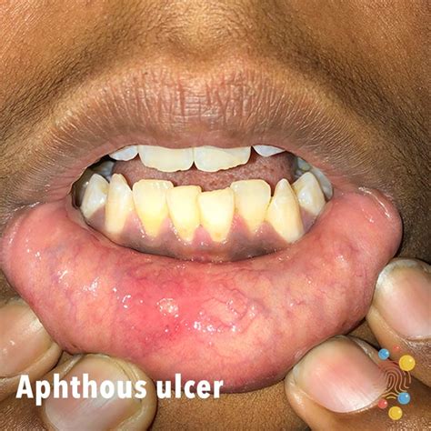 Aphthous Ulcer Skin Deep