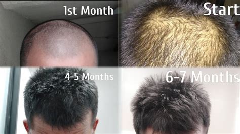 10 Months Results Minoxidil In Form Mode Rapid Hair Regrowth