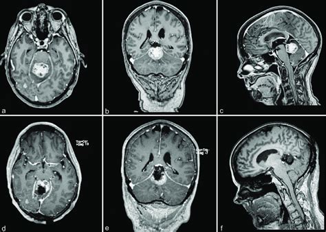 Magnetic Resonance Images For Patient 4 A Preoperative Postcontrast