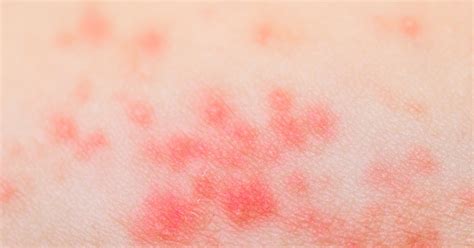 You might have one of these common skin conditions. 5 Things You Need to Know About Heat Rash | LIVESTRONG.COM