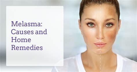Melasma Causes Home Remedies And Melasma Treatment Derma Essentia