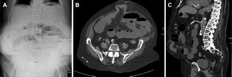 Incarcerated Umbilical Hernia After Colonoscopy In A Cirrhotic Patient