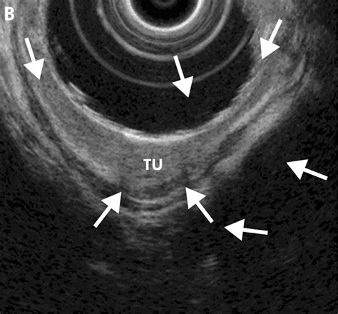 Endoscopic Ultrasonography Imaging And Beyond Gut