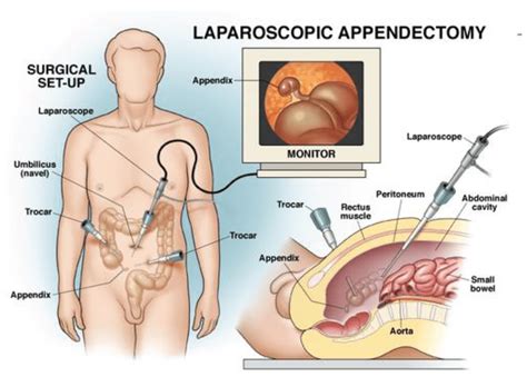 What Is Appendectomy And Different Types Of It