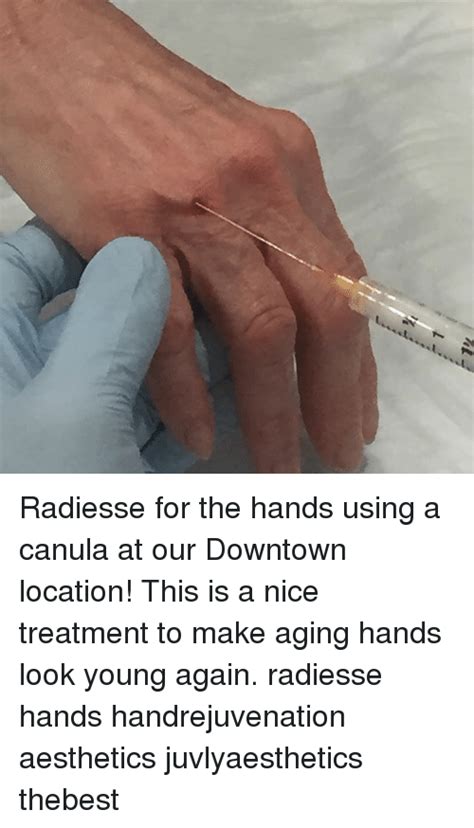 radiesse for the hands using a canula at our downtown location this is a nice treatment to make
