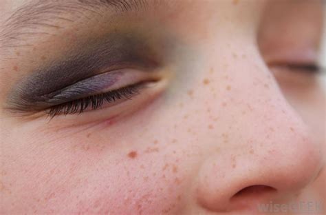 Having too few platelets (thrombocytopenia) may cause you to bleed or bruise easily. What can Cause a Black Bruise? (with pictures)