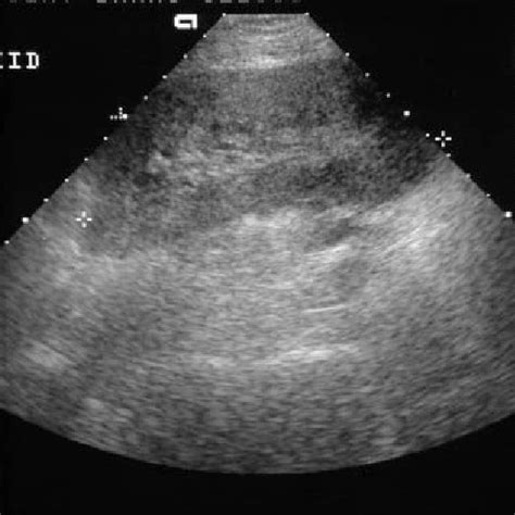 Renal Transplant Ultrasound Sonograph Prior To The Nephrostomy Tube