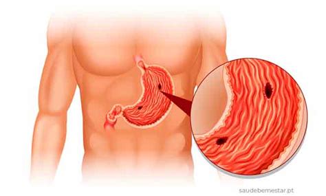 Úlcera no Estômago o que é causas sintomas tratamento