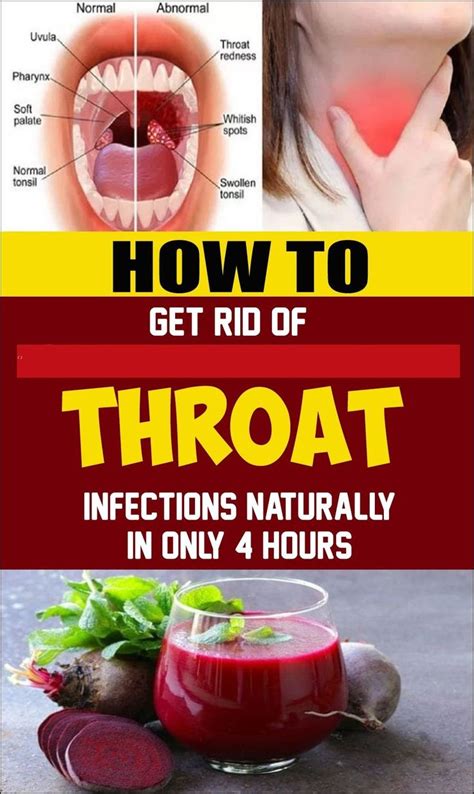 Instructions To Get Rid Of Throat Infections Naturally In Only 4 Hours