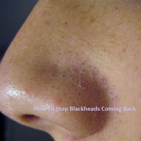 How To Stop Blackheads Coming Back My Acne Blog Best Acne