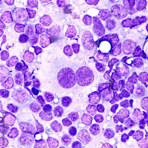 Microscopic Image Of Touch Prep Cytology Smear Of A Lymph Node In A
