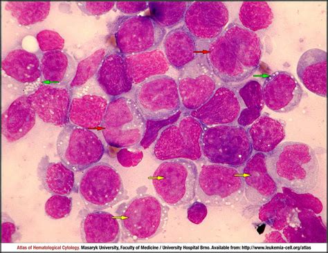 Peripheral T Cell Lymphoma Not Otherwise Specified Cell Atlas Of