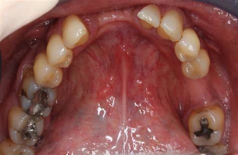 How Are Sinus Infections Related To Toothache Dental Implants