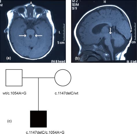 Brain Magnetic Resonance Imaging Mri Findings For The Joubert