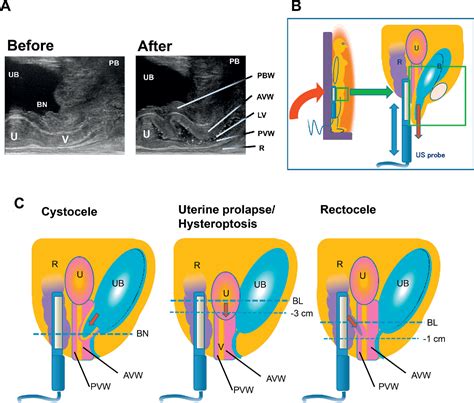 Figure 1 From Impact Of Dynamic Transrectal Ultrasonography On Pelvic