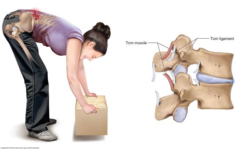 Sprains And Strains Of The Low Back And Pelvis
