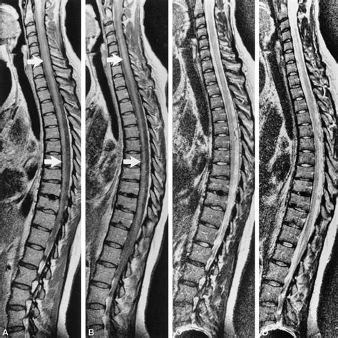 Clinical And Spinal Cord Mri Findings In 19 Multiple Sclerosis Patients