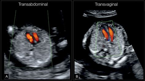 Fetal Cardiac Examination In Early Gestation Obgyn Key