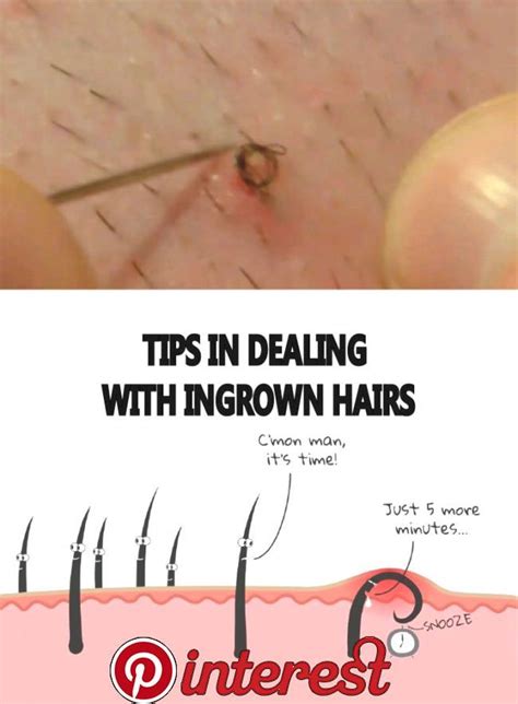 Tips In Dealing With Ingrown Hairs A Gadgets In 2019 Ingrown Hair