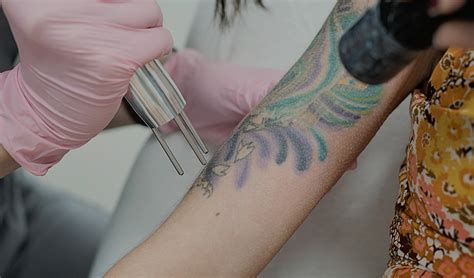 He told me the long i wait, scared i would be. Laser Tattoo Removal Services | LaserAway