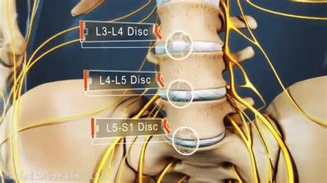 Lumbar Spine L3 L4 Disc L4 L5 Disc And L5 S1 Disc Lumbar Disc
