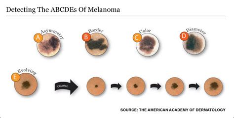 Skin Expert Melanoma Screening Is The Best Prevention