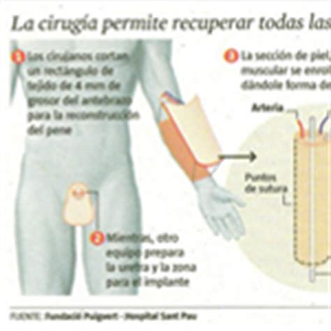 Jul 02, 2021 · tiago, da dupla com hugo, se submeterá à cirurgia de aumento peniano. Reconstrucción de pene (faloplastia) - Dr. Jorge Planas blog