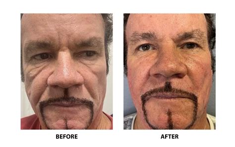 Boston Thread Lift Non Surgical Face Lift Before And After Dr Numa