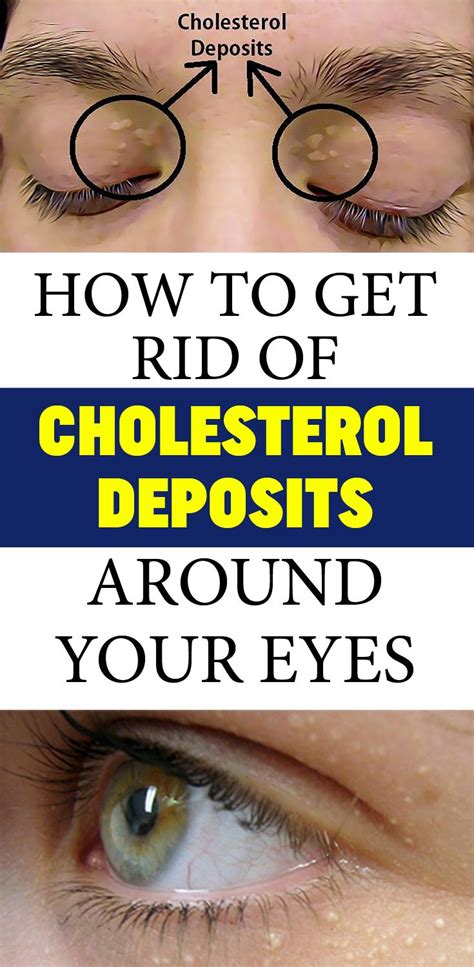 How To Get Rid Of Cholesterol Deposits Around Your Eyes With Images
