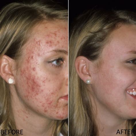 Retinol Before And After Acne Scars
