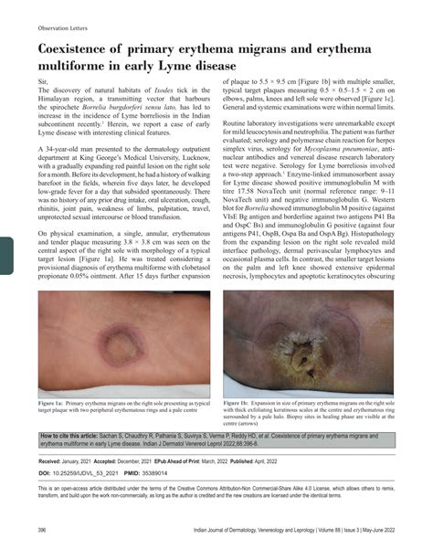 Pdf Coexistence Of Primary Erythema Migrans And Erythema Multiforme