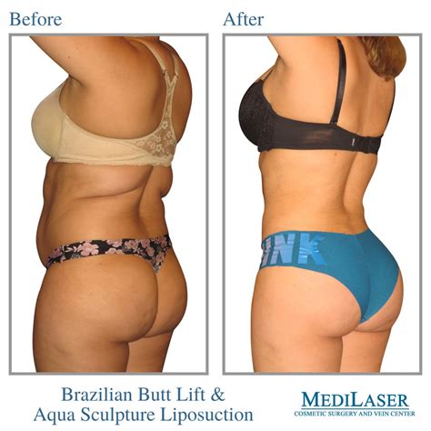 Brazilian Butt Lift Before And After Medilaser Surgery And Vein Center