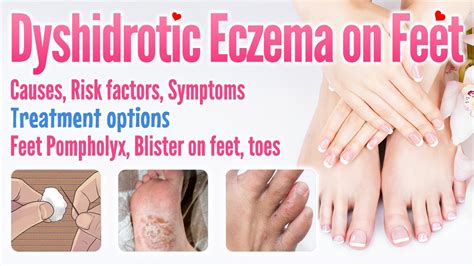 Dyshidrotic Eczema On Feet Causes Symptoms Risk Factors Treatment Options Feet Pompholyx