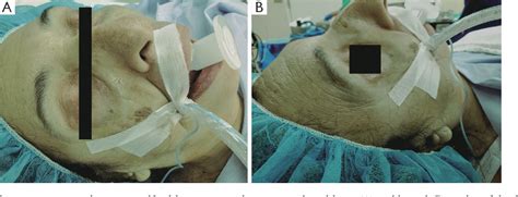 Figure 1 From Diffuse Skin Staining After Using Isosulfan Blue For