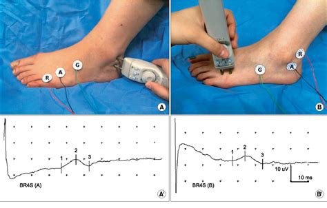 Table 3 From Nerve Conduction Study Of The Superficial Peroneal Sensory