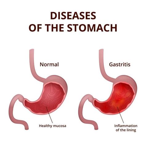 Stomach Polyps Symptoms Causes Diet Treatment Stdgov Blog