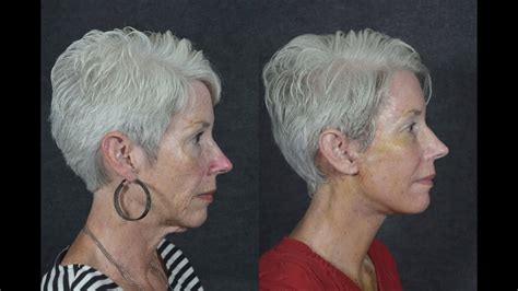 Rapid Facelift Recovery For 62 Year Old Woman 1 Week After Surgery