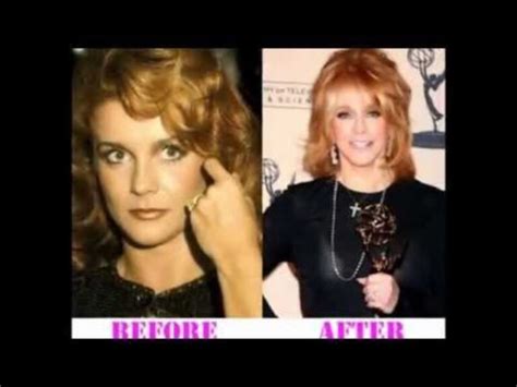 Ann Margret Accident Before And After Face Injury