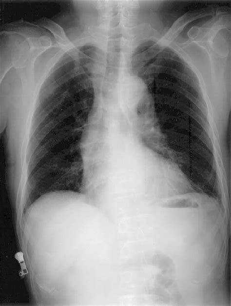 Aorta Chest X Ray